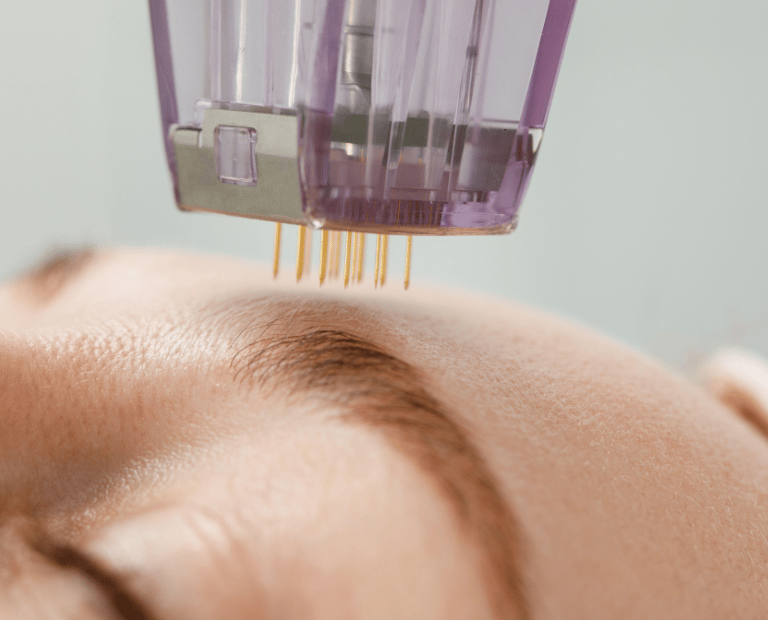 closeup of microneedling treatment on persons eyebrow area
