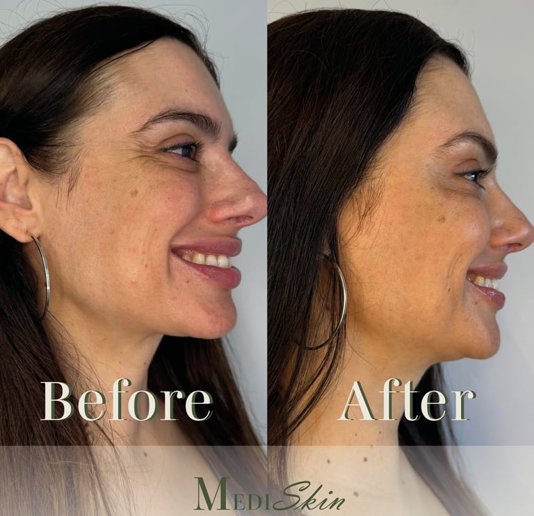 Before and after results of anti-wrinkle injections at MediSkin Rejuvenate Clinic in Oxford