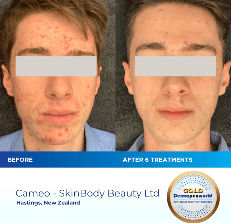 a man before and after dermapen 4