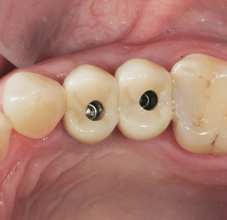 Dental crowns and bridges as restorative dental care solutions to strengthen teeth and replace missi