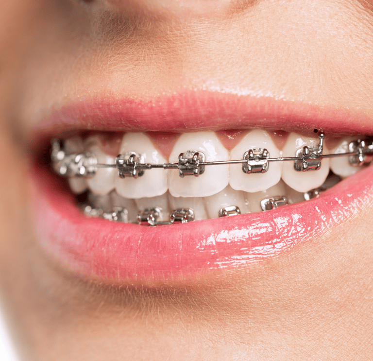 Teeth with traditional metal braces, showing durable and time-tested orthodontic care