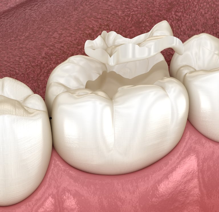 Dental professional fitting a replacement crown on a patient’s tooth after crown loss