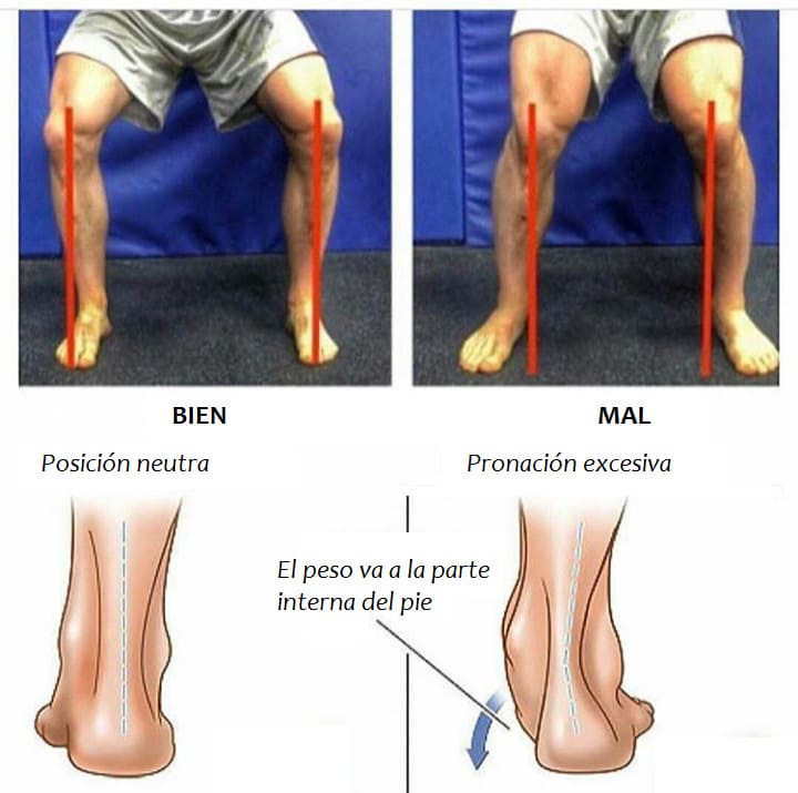 Comparativa de sentadilla bien alineada vs. con desalineación de rodilla