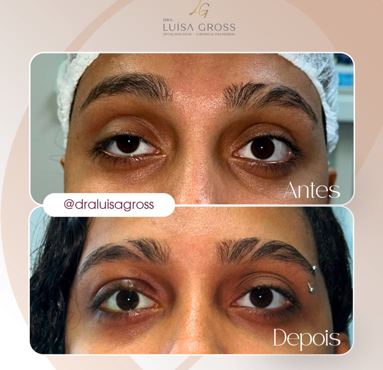Antes e depois de cirurgia periocular realizada pela Dra. Luisa Gross