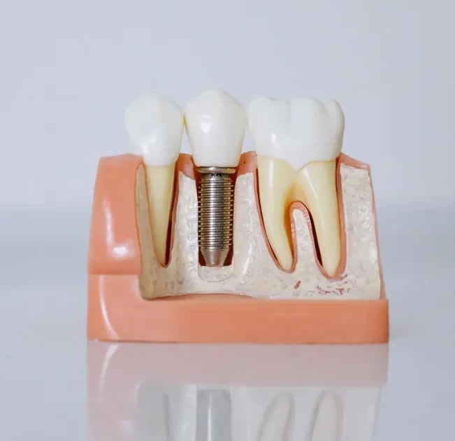 Implantes dentales en Sevilla