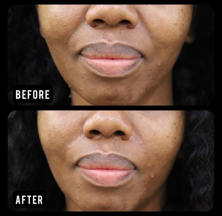 fat transfer for face