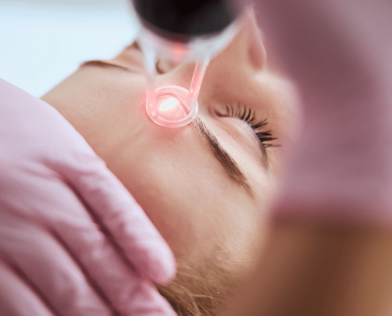 close up of laser skin treatment on woman's forehand