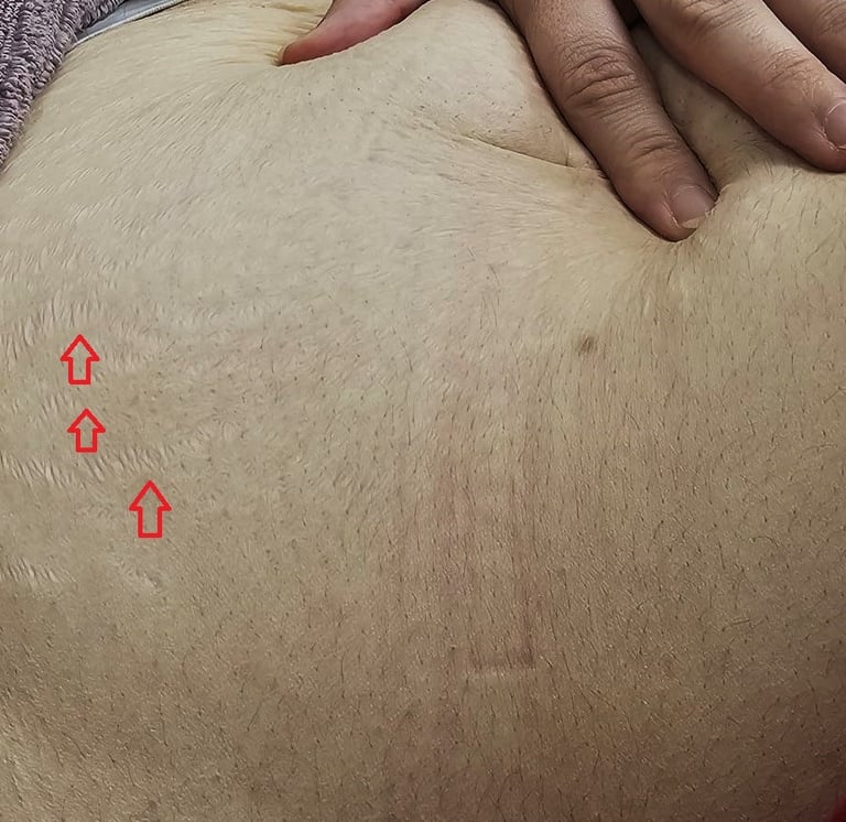 Abdominal stretch marks caused by pregnancy in a woman, before treatment at Ariana Esthetic Edmonton