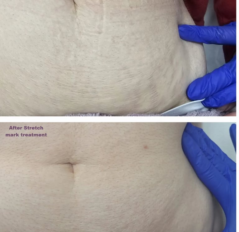Significant improvement results in abdominal stretch mark treatments at Ariana Esthetic Edmonton.