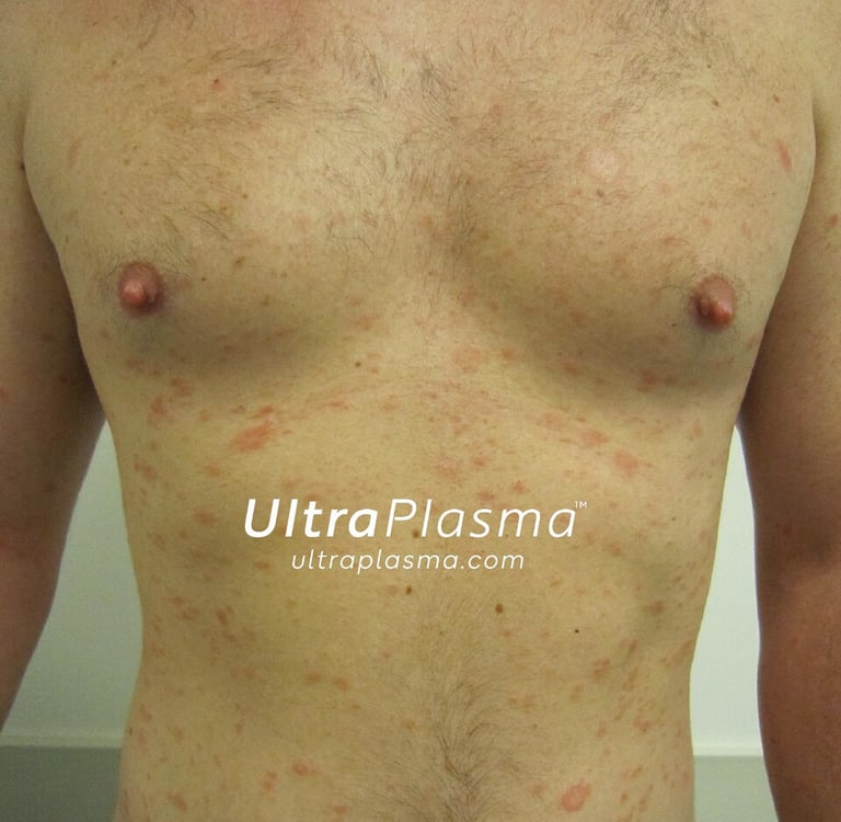 ultraplasma.com_Pityriasis_Rosea_treatment_ultra_plasma_ultra_plazma_1