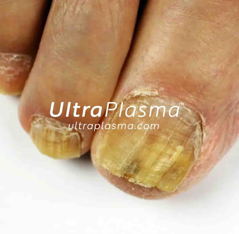 nail_fungus_onychomycosis_ultra_plasma_ultra_plazma_ultra-plasma_ultra-plazma