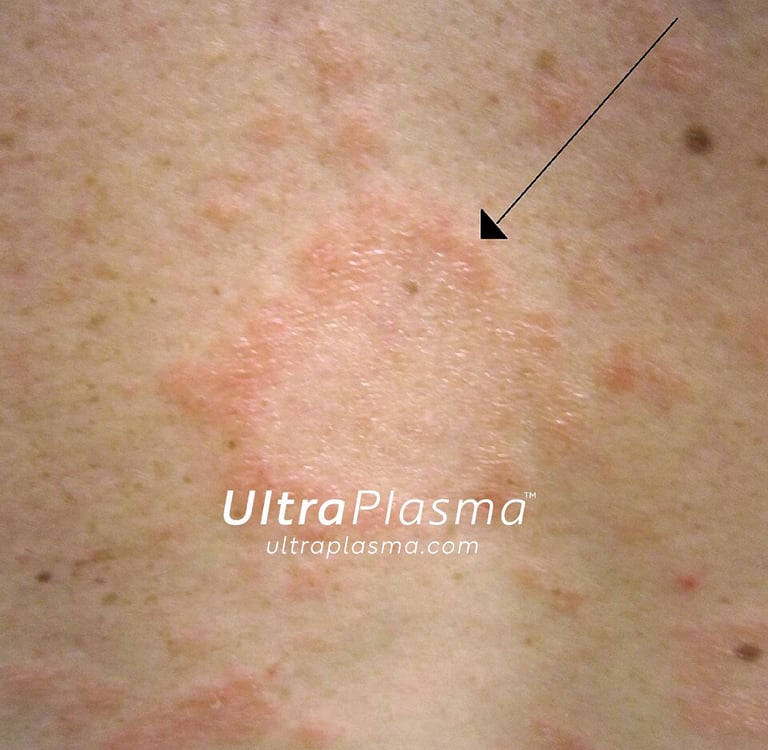 ultraplasma.com_Pityriasis_Rosea_treatment_ultra_plasma_ultra_plazma