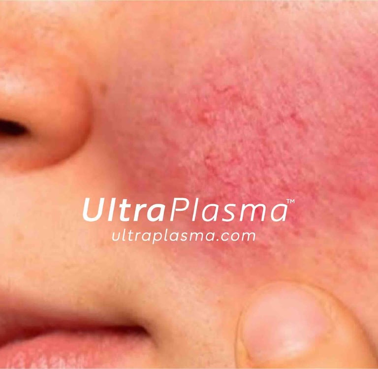 rosacea_roza_hastaligi_tedavi_treatment_ultra_plasma_ultra_plazma_ultra-plasma_ultra-plazma