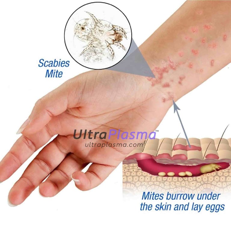 ultraplasma.com_Sarcoptes_scabiei_Infestation_Treatment_ultra_plasma_ultra_plazma