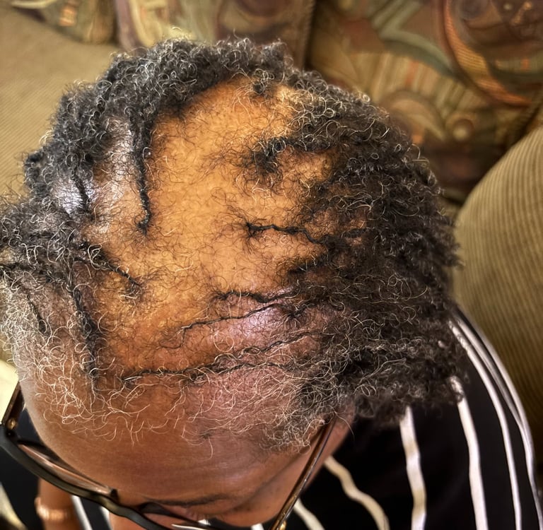 Close-up of a person with thinning graying hair and visible scalp showing signs of female pattern baldness or alopecia.