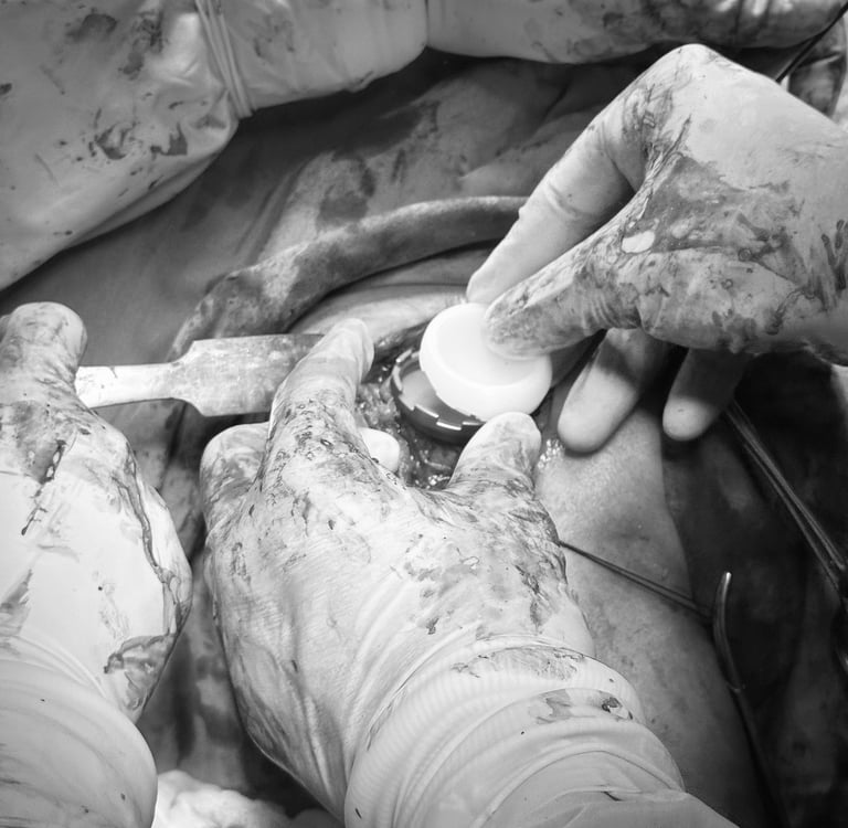 Colocación de vastago de húmero en prótesis reversa de hombro.