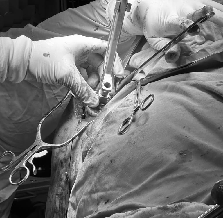 Preparación de canal medular de húmero en prótesis reversa de hombro