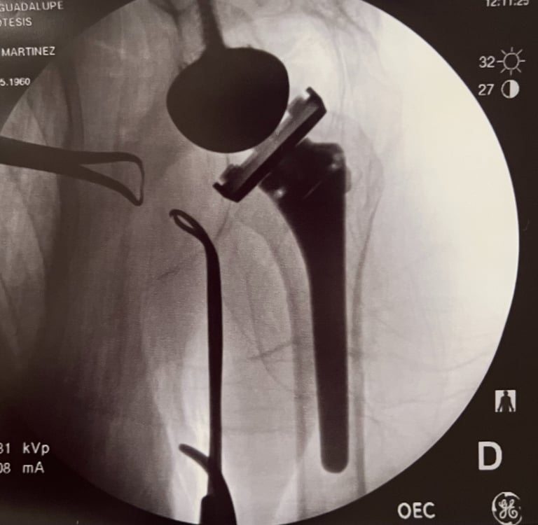 Control de radiografía de prótesis reversa de hombro.