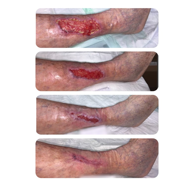 Abheilung eines Ulcus cruris