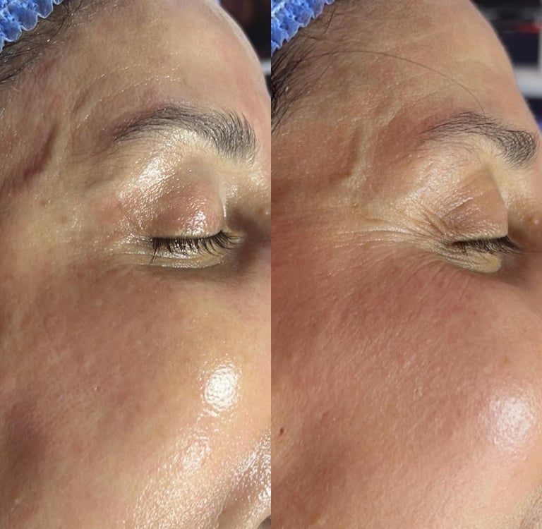 Comparaison avant et après en gros plan de la peau d’un client, montrant une amélioration visible de