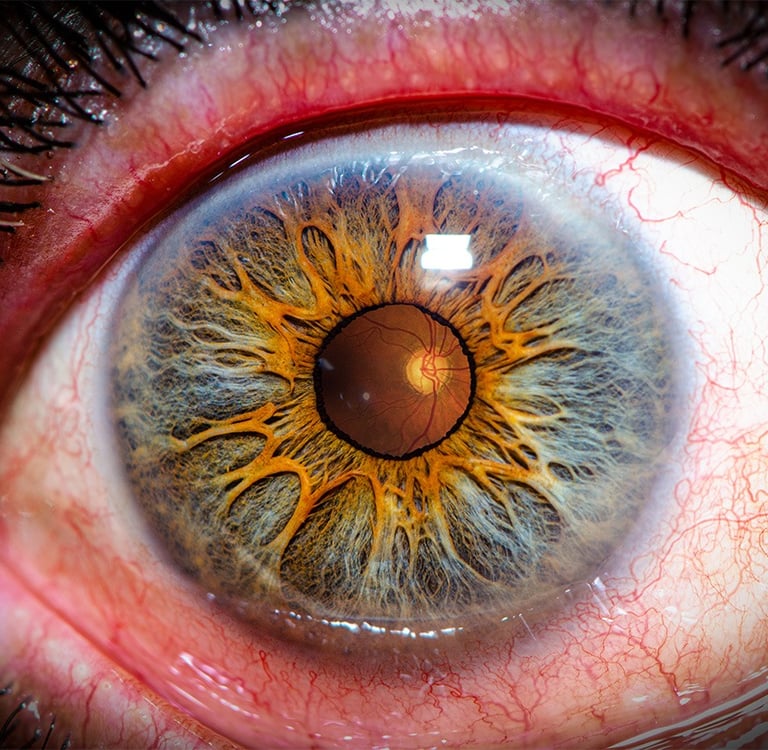 Foto de ojo con glaucoma