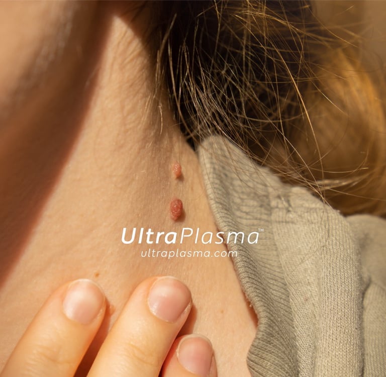 ultraplasma.com_skin_tag_removal_treatment_et_beni_temizleme_silme_tedavi_ultra_plasma_ultra_plazma