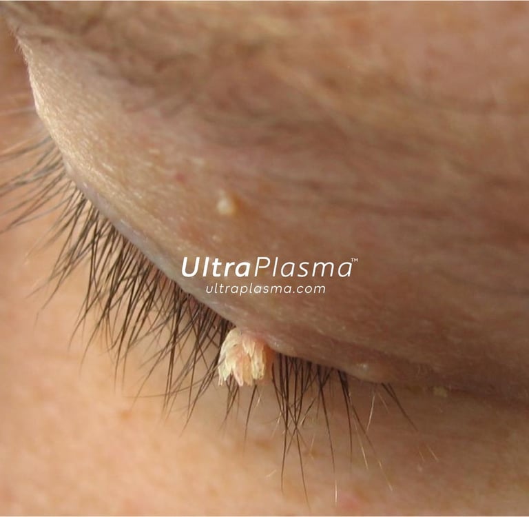 ultraplasma.com_wart_treatment_sigil_tedavisi_ultra_plasma_ultra_plazma