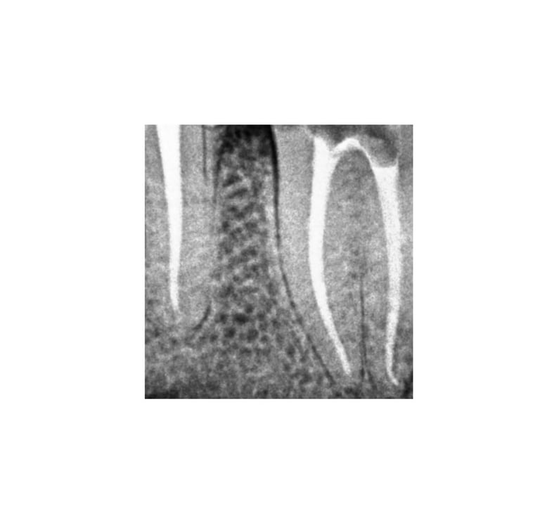 Root Canal Treatment - RCT Specialist Dentist in Greater Noida