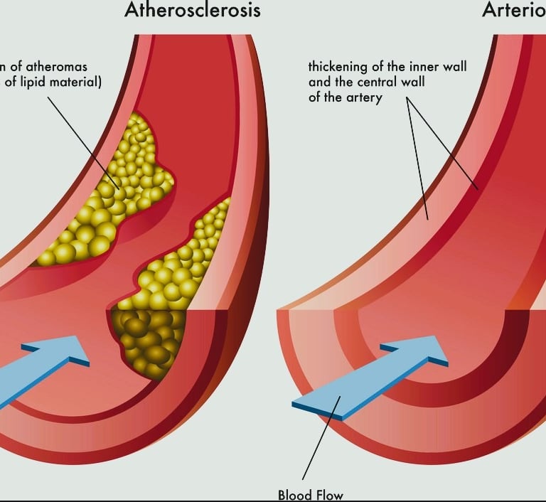Arteriosclerosis