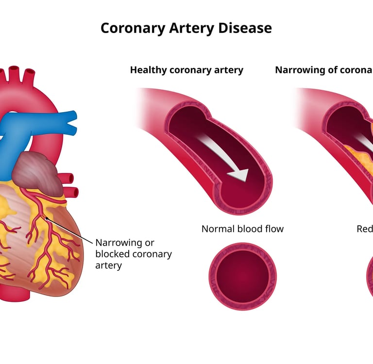 coronary artery disease