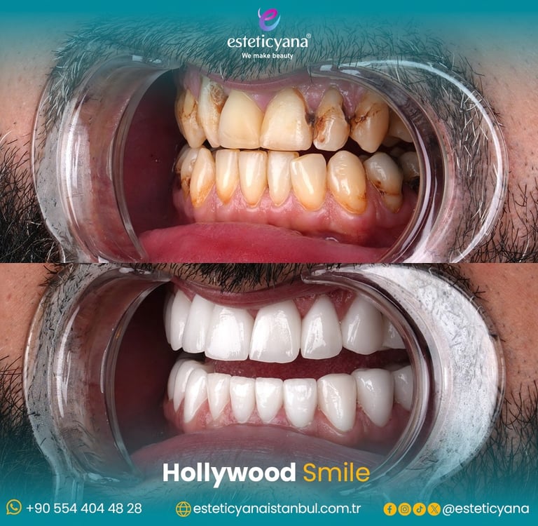 Hollywood smile before and after