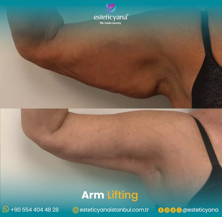 Arm lift before and after