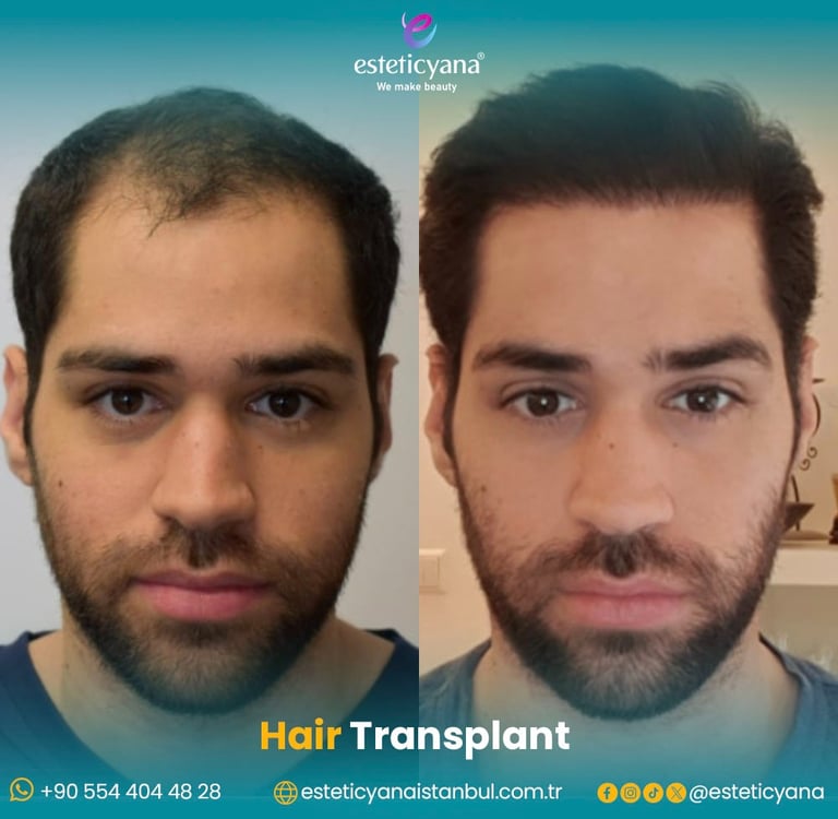 hair transplant before and after