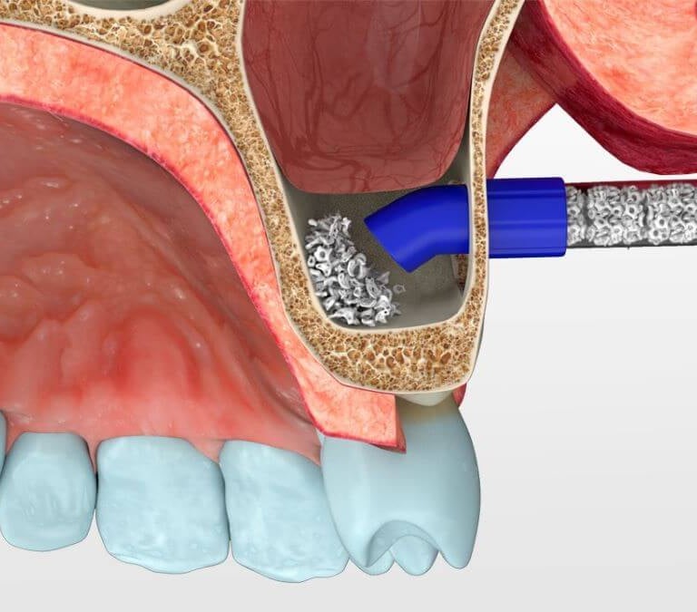 cirujano para injerto oseo