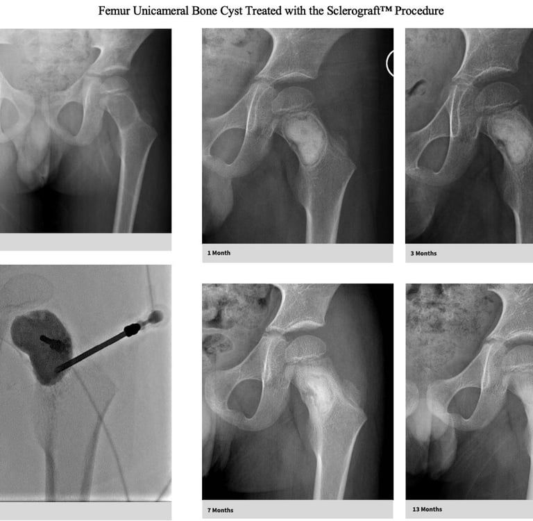xray-unicameral-bone-cyst-femur-sclerograft.jpg