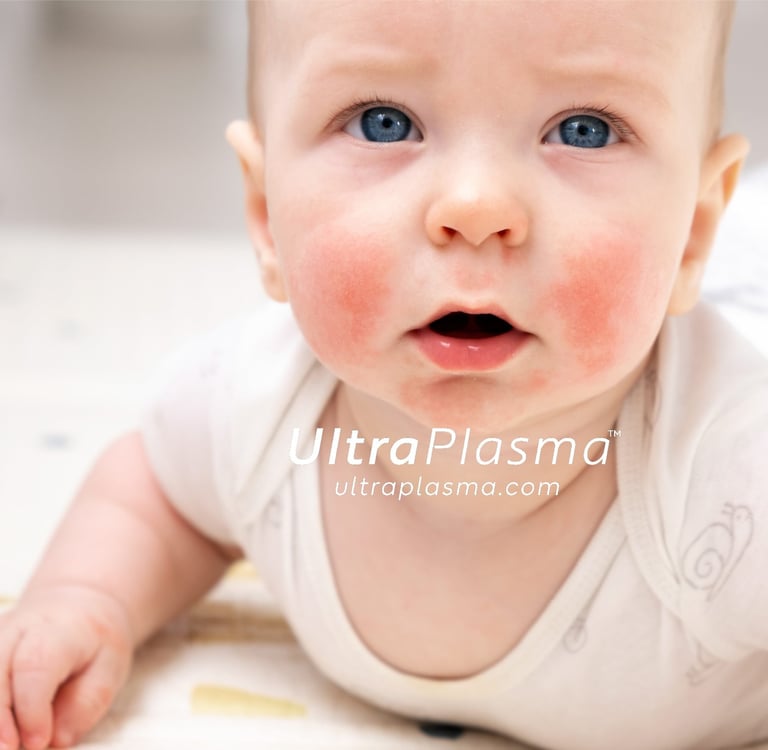 atopic_dermatitis_atopic_dermatit_egzama_eczemaultra_plasma_ultra_plazma_ultra-plasma_ultra-plazma