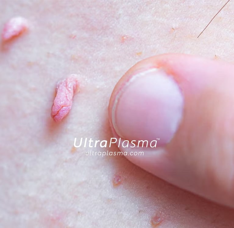 ultraplasma.com_skin_tag_removal_treatment_et_beni_temizleme_silme_tedavi_ultra_plasma_ultra_plazma2