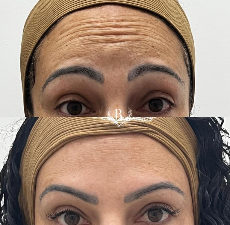 aplicação de toxina botulínica no rosto - clínica Tatuapé