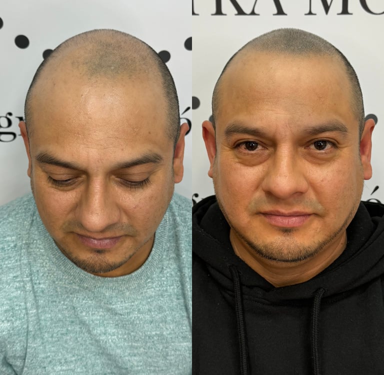 Micropigmentacion capilar madrid efecto rapado zulayka moreno
