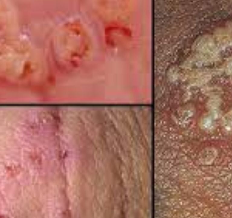 الهريس  التناسلى