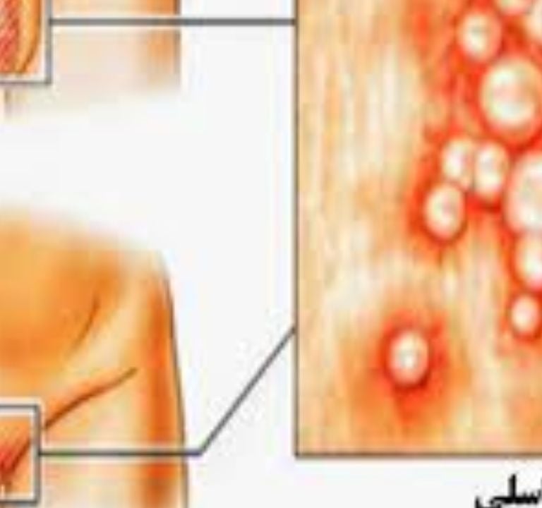 الهربس التناسلى يعلج بالعسل