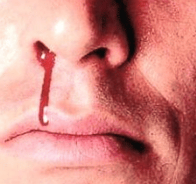 Epistaxis  Natural Remedi - fasting