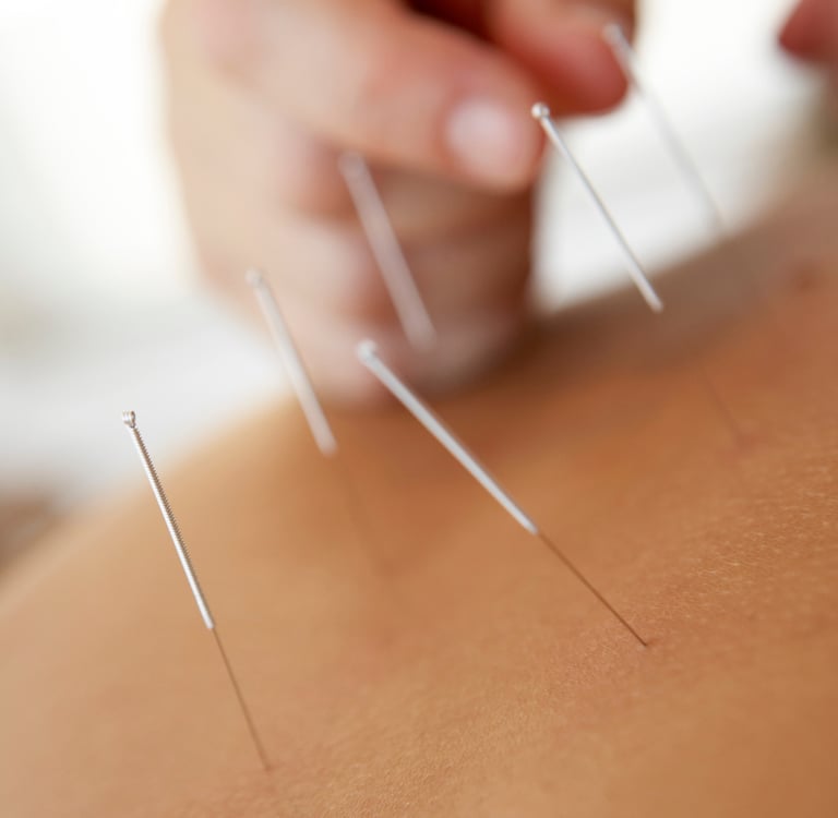 Une personne se fait poser des aiguilles d'acupuncture lors d'une séance de médecine chinoise