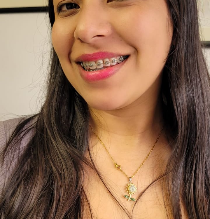 Sonrisa perfecta después de ortodoncia en DUPRINS Lima - Brackets y alineadores dentales