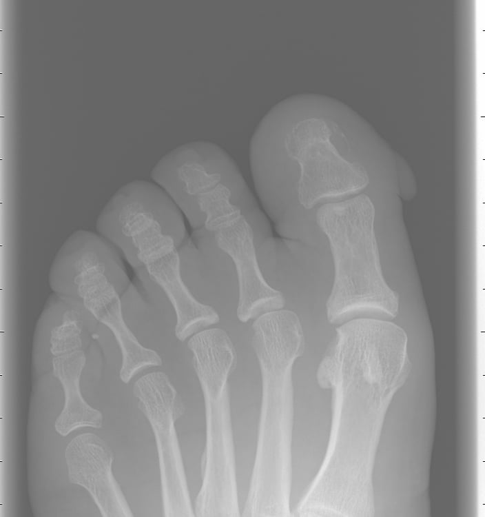 radiografía de fibroqueratoma digital