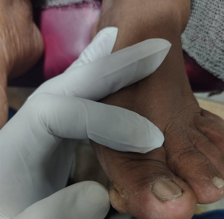 fibroqueratoma digital 