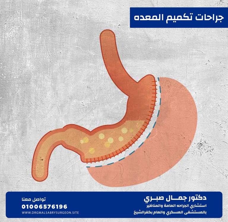 جراحات تكميم المعده كفرالشيخ