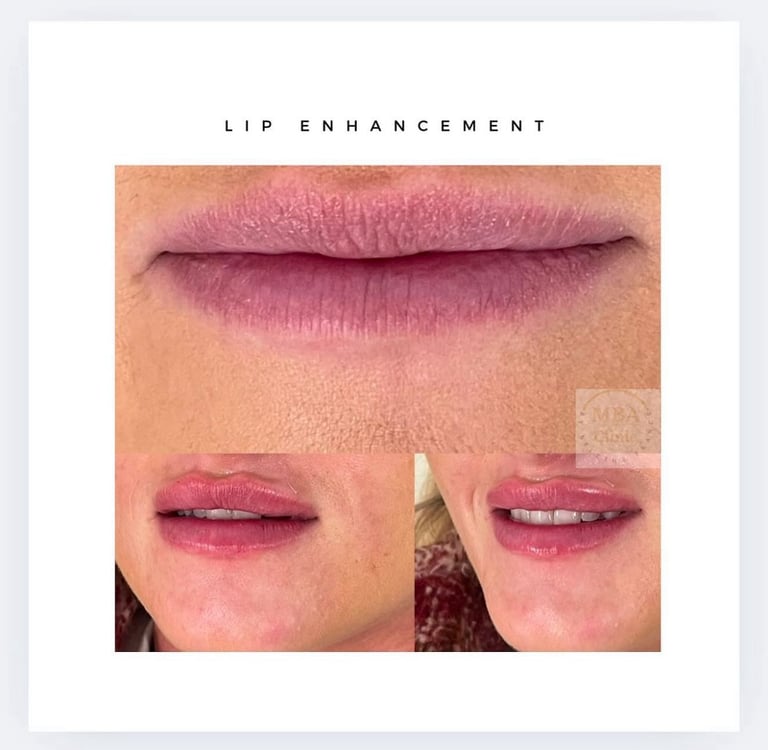 Lip filler at MA SALONS