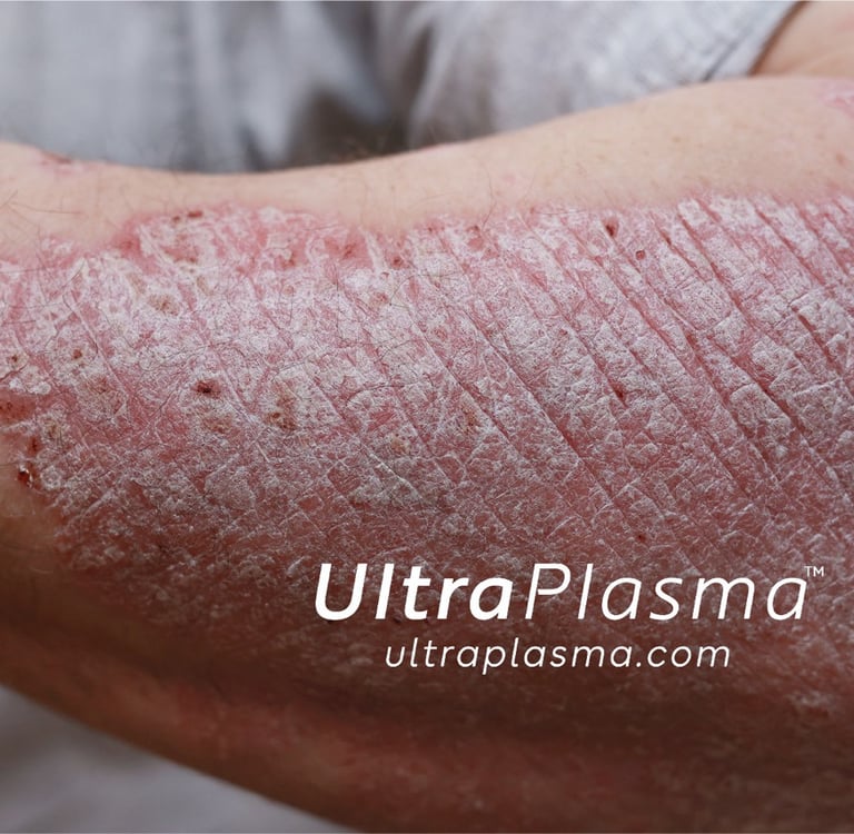 ultraplasma.com ultra plasma ultra plazma psoriasis sedef treatment tedavi