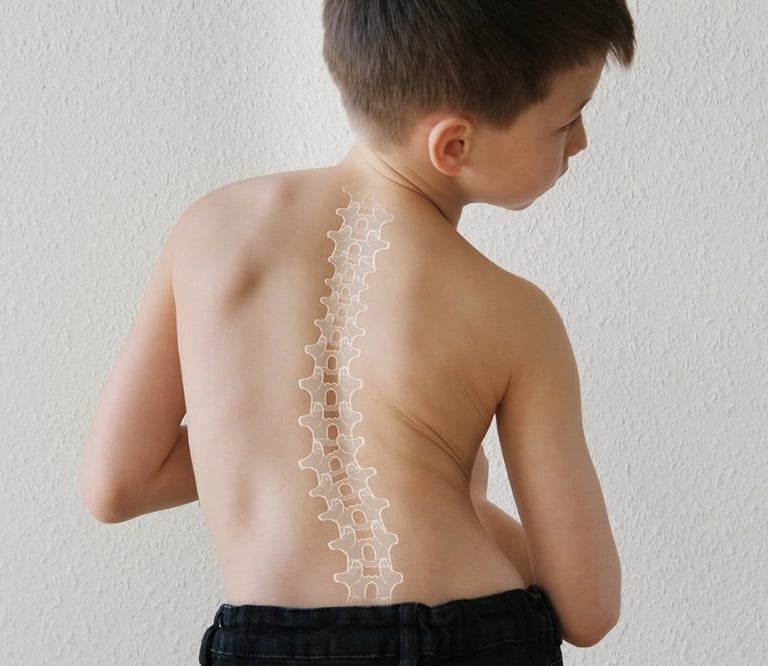 Scoliosis & Spinal Deformities at Bone Care One Day Surgery Center